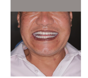 CẤY GH&Eacute;P IMPLANT TO&Agrave;N H&Agrave;M