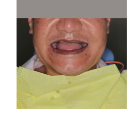 CẤY GH&Eacute;P IMPLANT TO&Agrave;N H&Agrave;M