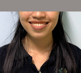 NIỀNG RĂNG MẮC C&Agrave;I KIM LOẠI