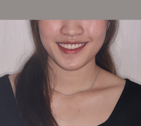 NIỀNG RĂNG MẮC C&Agrave;I KIM LOẠI