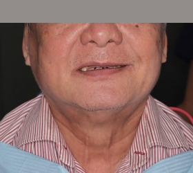 CẤY GH&Eacute;P IMPLANT TO&Agrave;N H&Agrave;M