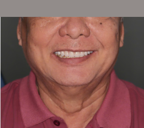 CẤY GH&Eacute;P IMPLANT TO&Agrave;N H&Agrave;M