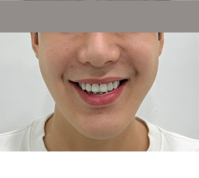 RĂNG SỨ THẨM MỸ