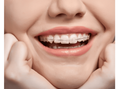 NIỀNG RĂNG MẮC C&Agrave;I SỨ