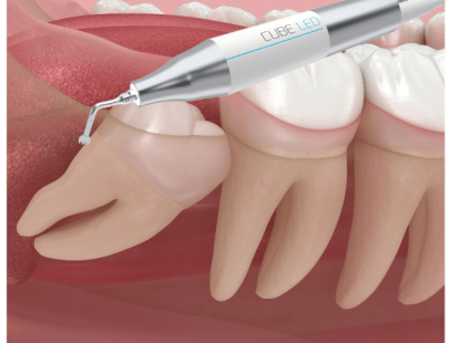 NHỔ RĂNG BẰNG M&Aacute;Y SI&Ecirc;U &Acirc;M PIEZOTOM