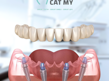 Cấy gh&eacute;p Implant to&agrave;n h&agrave;m 
