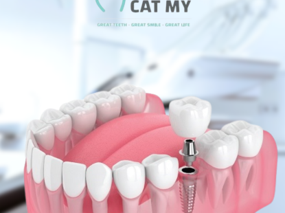 CẤY GH&Eacute;P IMPLANT NHA KHOA