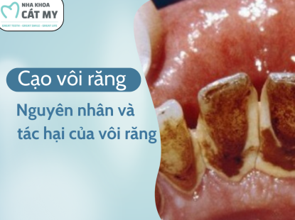 V&Ocirc;I RĂNG - NGUY&Ecirc;N NH&Acirc;N V&Agrave; T&Aacute;C HẠI CỦA V&Ocirc;I RĂNG