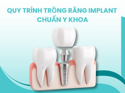QUY TR&Igrave;NH TRỒNG RĂNG IMPLANT CHUẨN Y KHOA