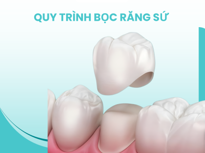 QUY TR&Igrave;NH BỌC RĂNG SỨ THẨM MỸ