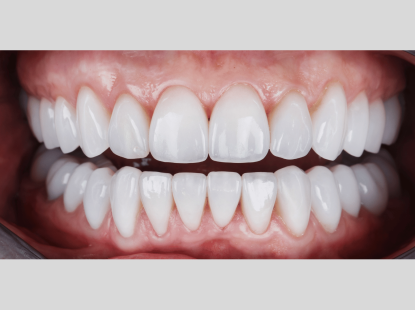 RĂNG SỨ NHA KHOA THẨM MỸ