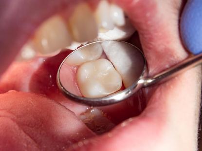 TR&Aacute;M RĂNG THẨM MỸ