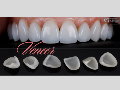 D&aacute;n Răng Sứ Veneer 