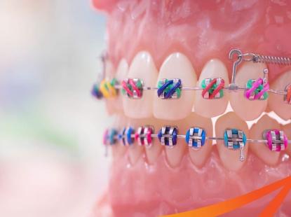 NIỀNG RĂNG MẮC C&Agrave;I KIM LOẠI